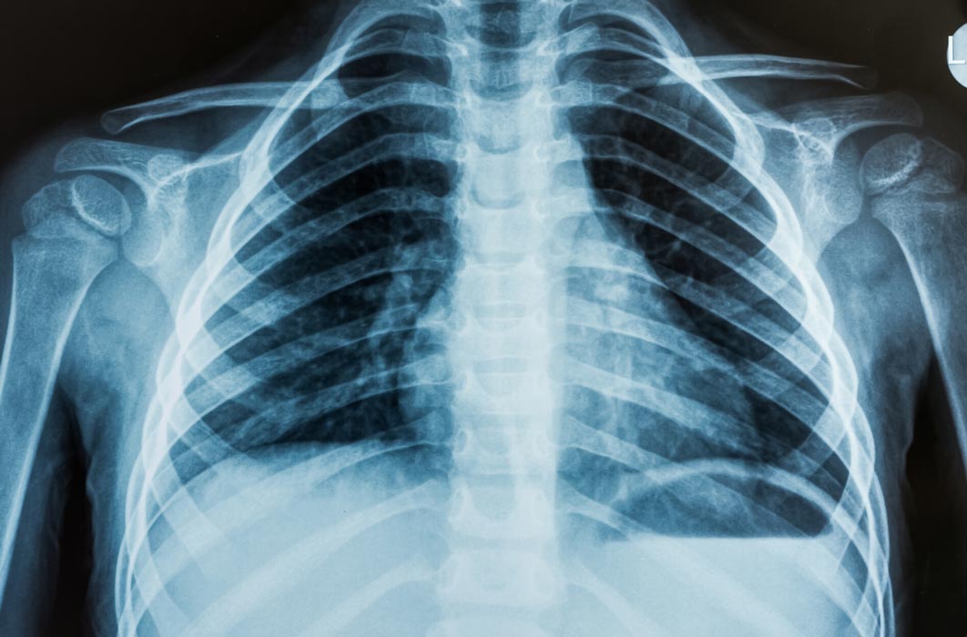 Chest x-ray